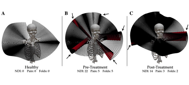 Teaser image for Instantaneous helical axis methodology to identify aberrant neck motion