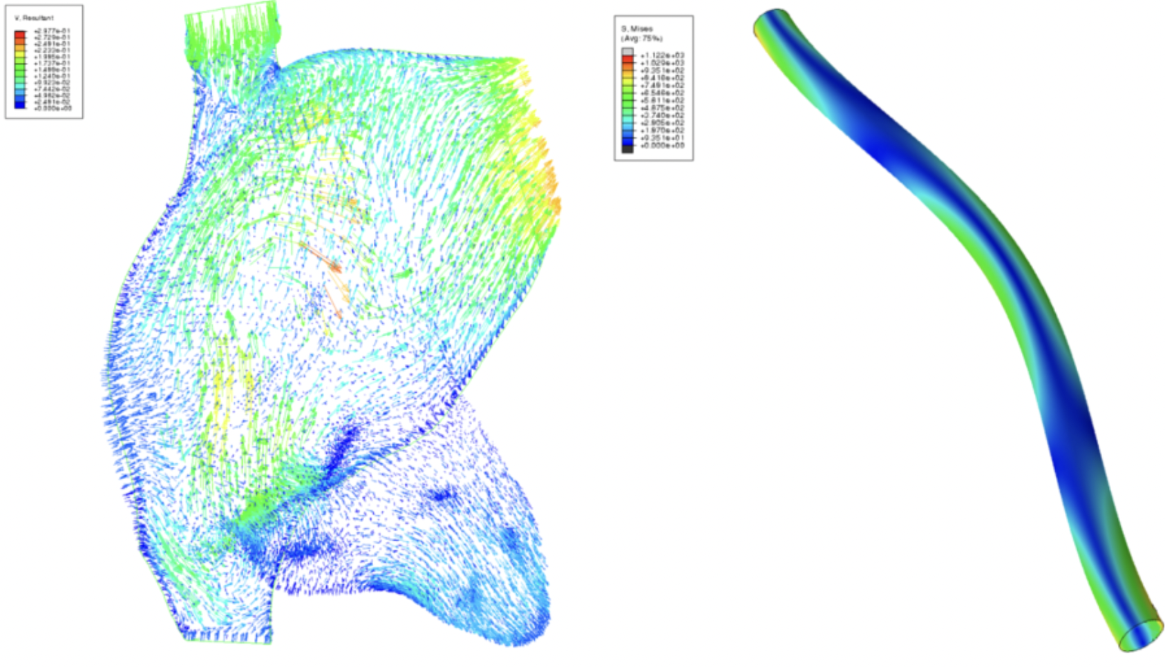 Teaser image for Podium Presentation: Fluid-Structure Interaction Simulation of Cardiac Leads in the Heart: Developing a Computational Model for use in Medical Device Design